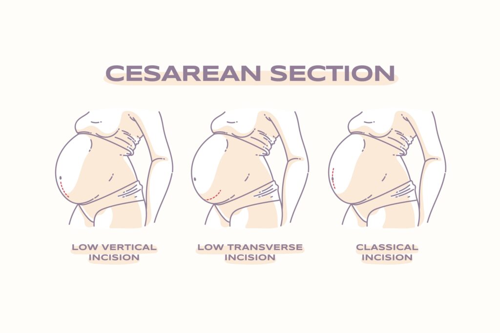 C section